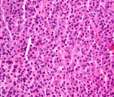 plasmacytoma1