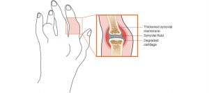 Fig. 1. Effect of rheumatoid arthritis on a joint.